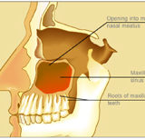 Sinuziti Maksilar Odontogjen